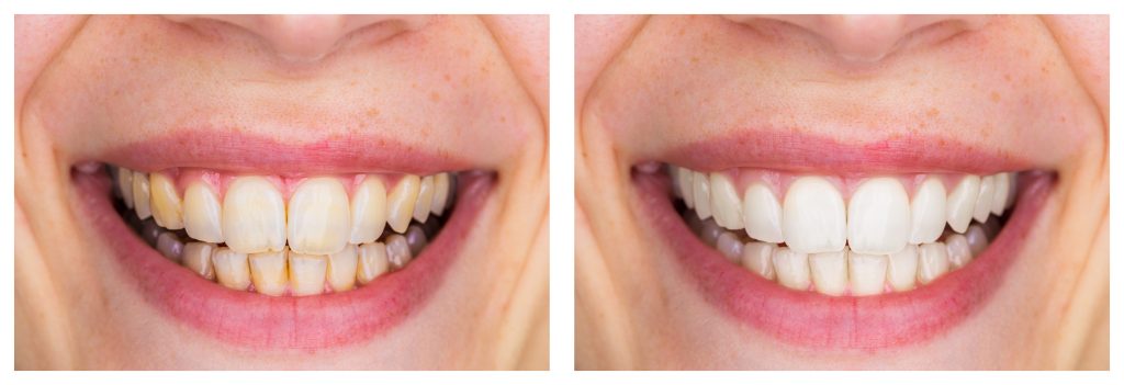 Whitening - Dental care, a beautiful smile and teeth whitening t