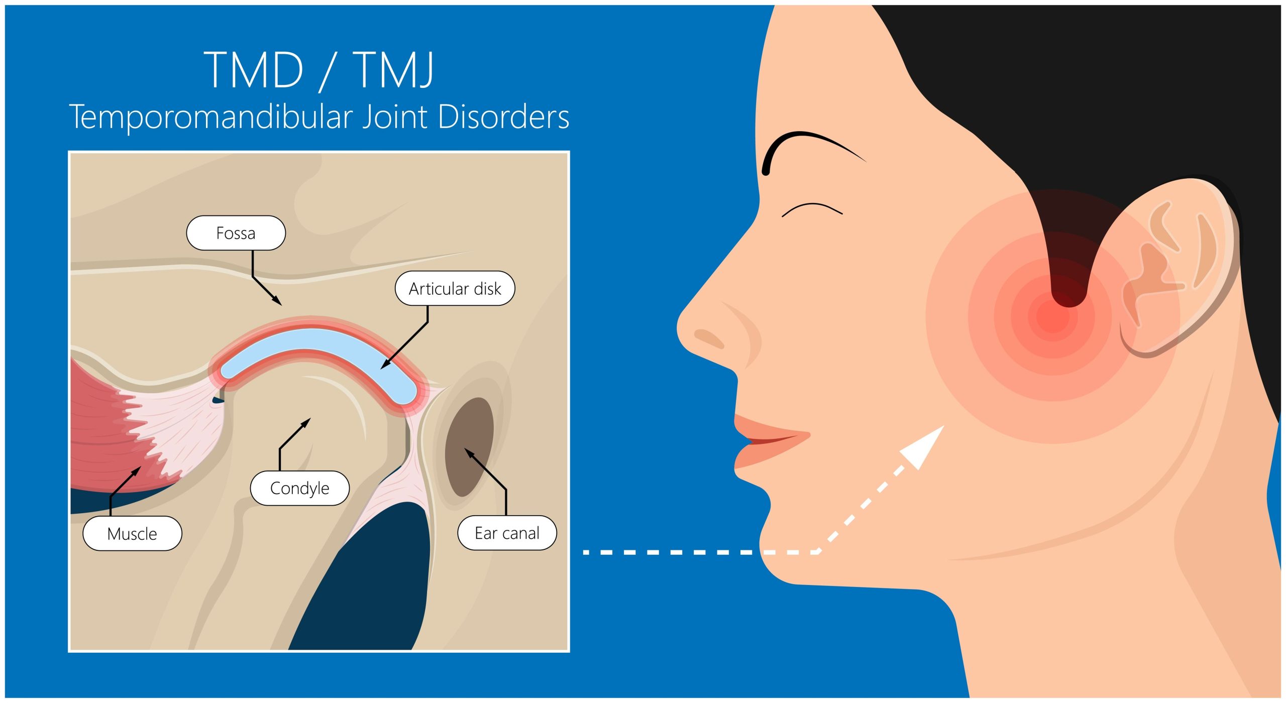 TMD Explanation TMD Explanation