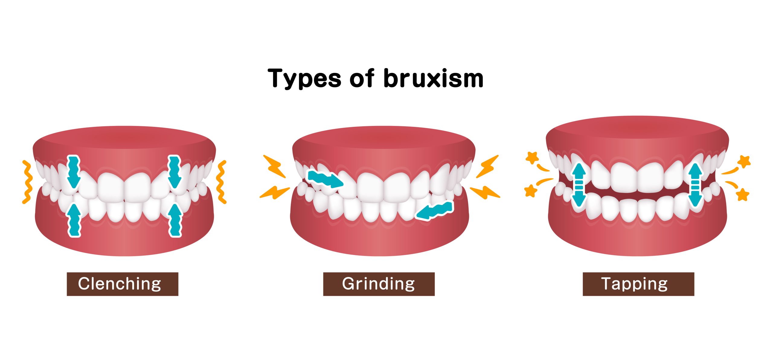 Types of bruxism (teeth grinding) vector illustration