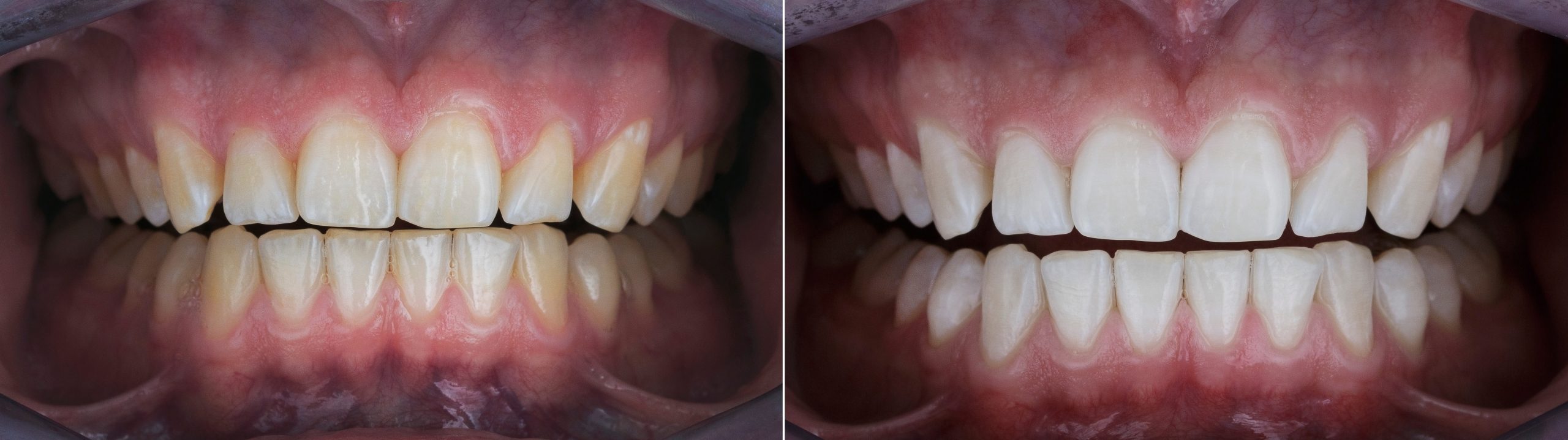 dental photo comparison before and after teeth whitening dental photo comparison before and after teeth whitening
