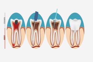 Root-Canals-Treatment Root-Canals-Treatment