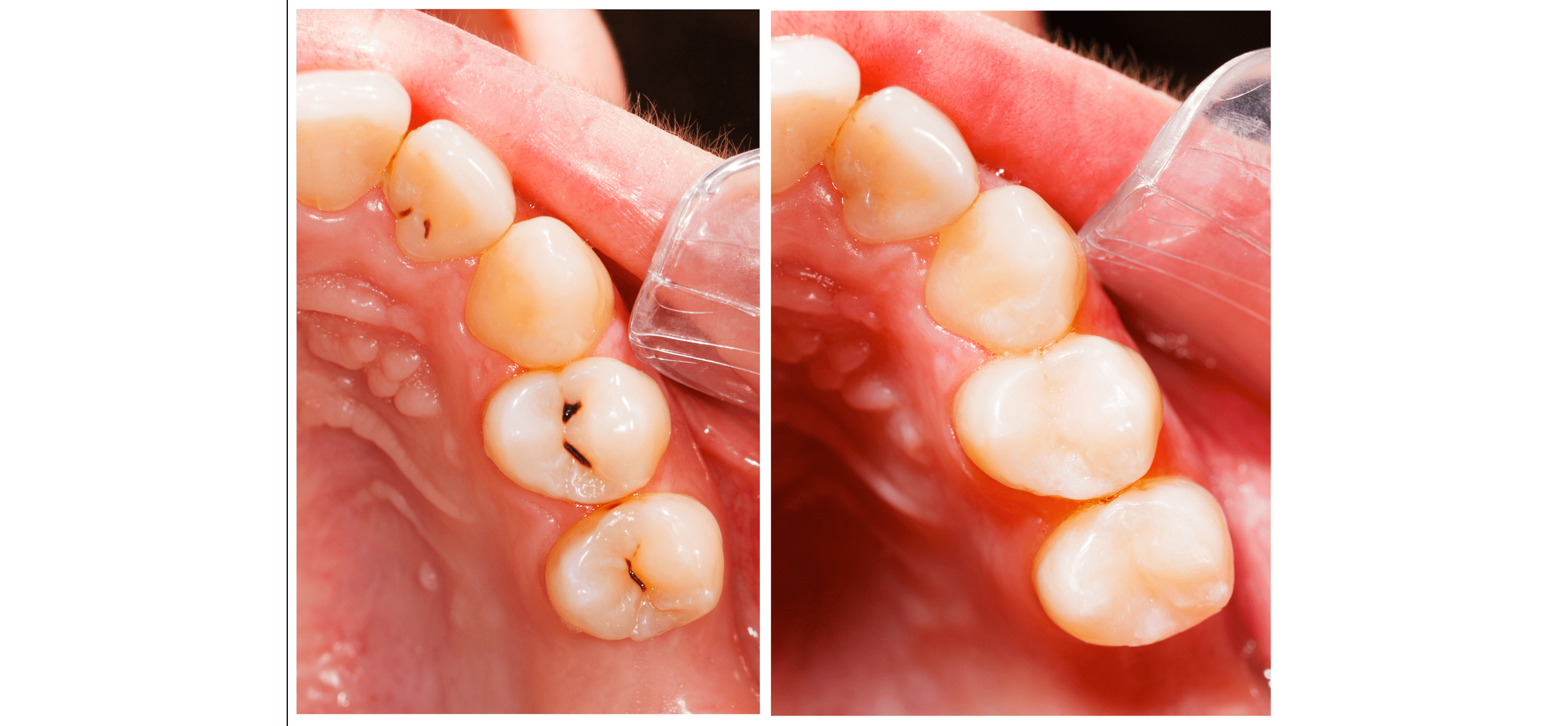 Dental Filling Image Example Dental Filling Image Example