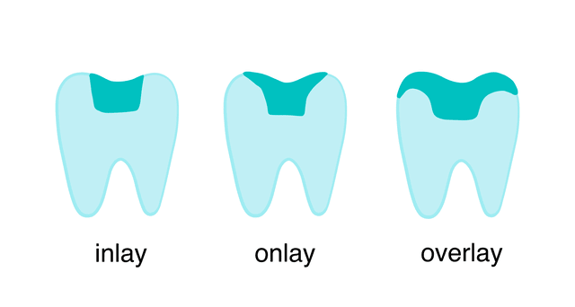Dental Inlays and Onlays Dental Inlays and Onlays