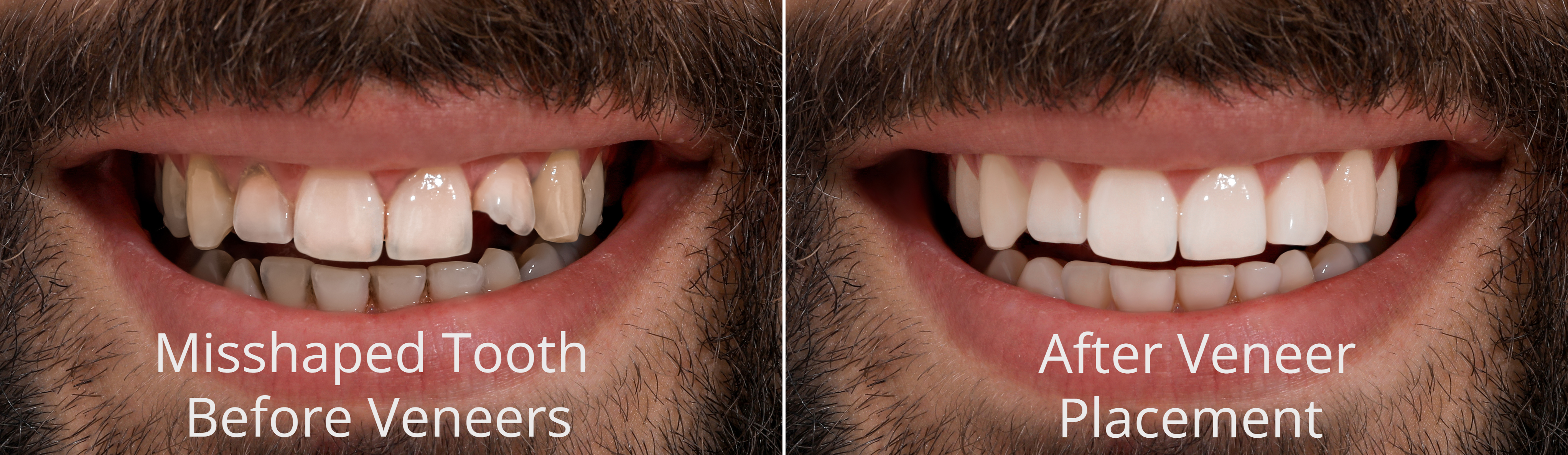 Dental Veneer Before and After