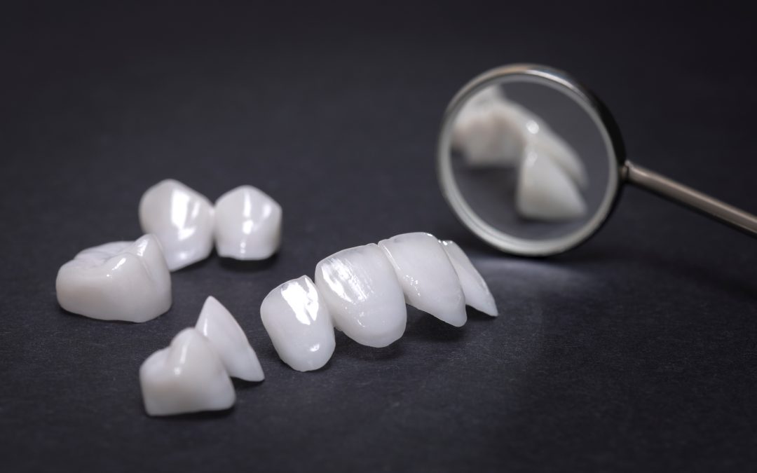 Dental Bonding vs. Veneers: Which Option is Right for You?