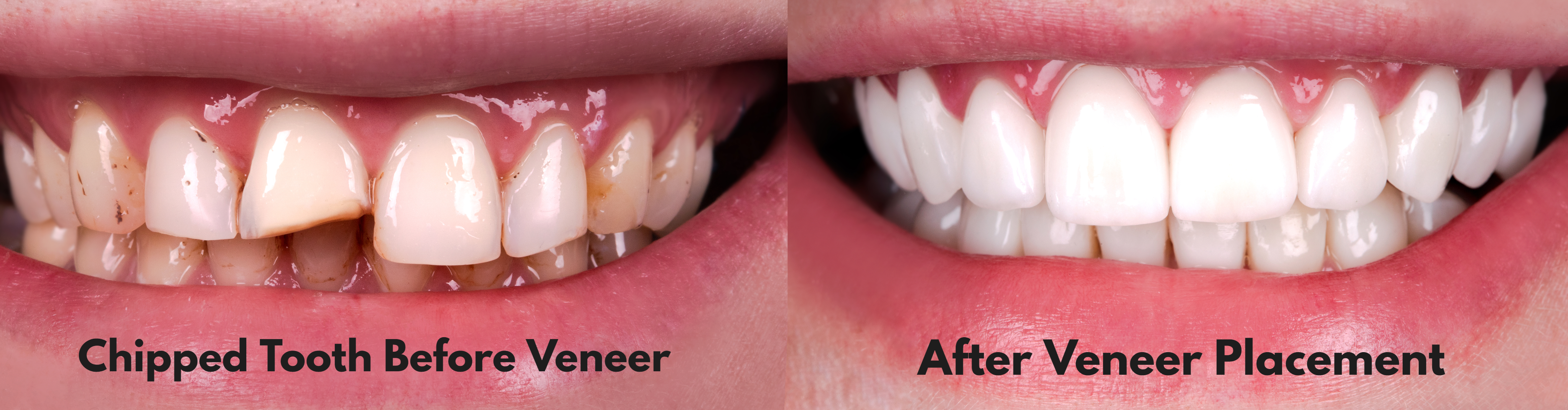 Dental Veneers Before and After Dental Veneers Before and After