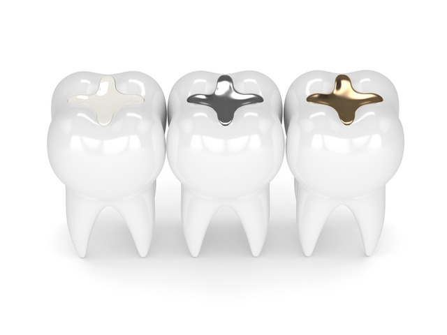Dental Fillings St Albert Dental Fillings St Albert
