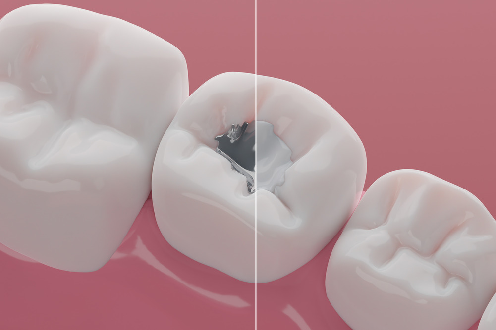 Understanding Composite Fillings: Everything You Need to Know