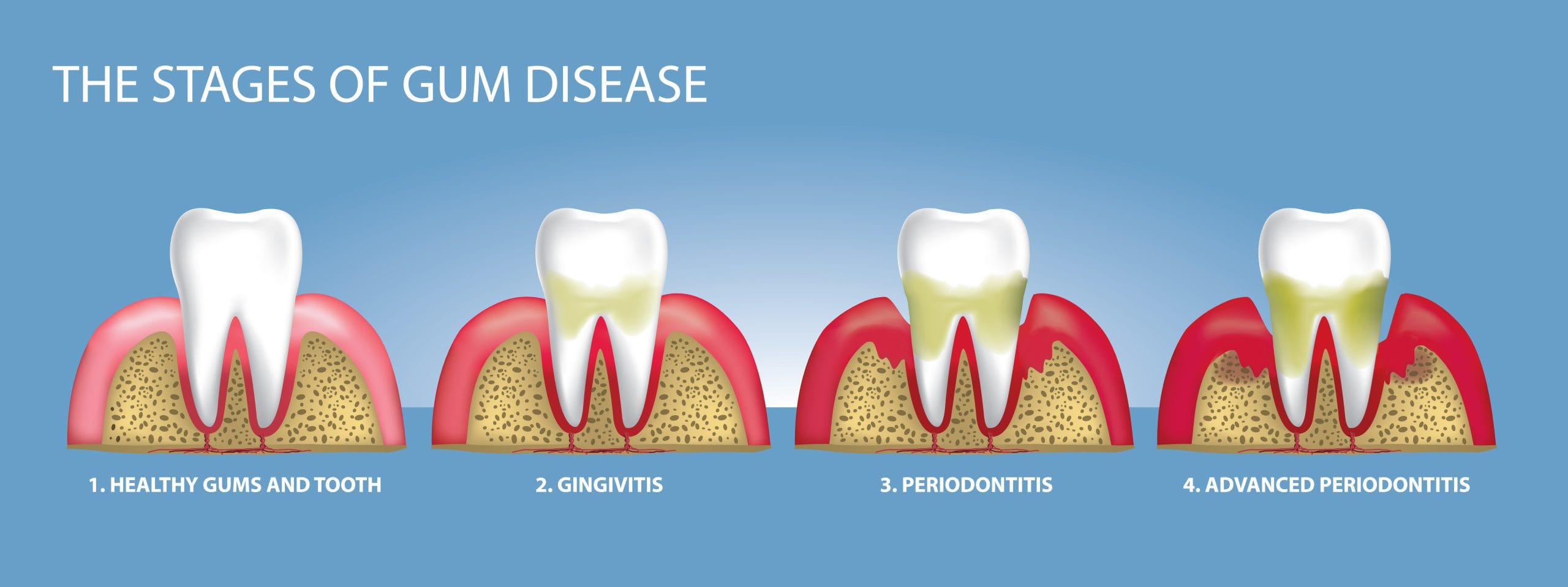How Gum Disease Develops