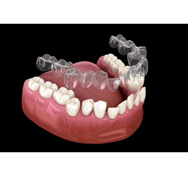 Invisalign - What to Expect from Start to Finish - MH Dental