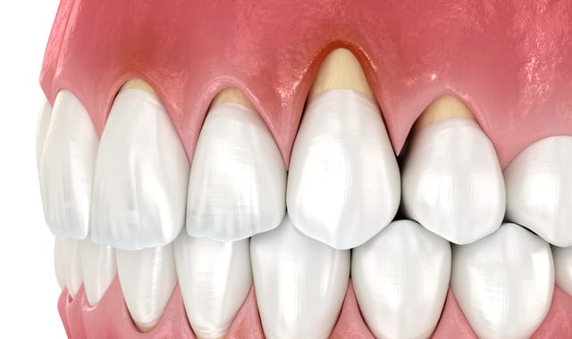 Tooth and gum recession