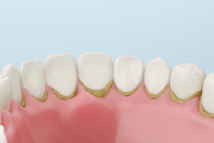 Plaque Buildup