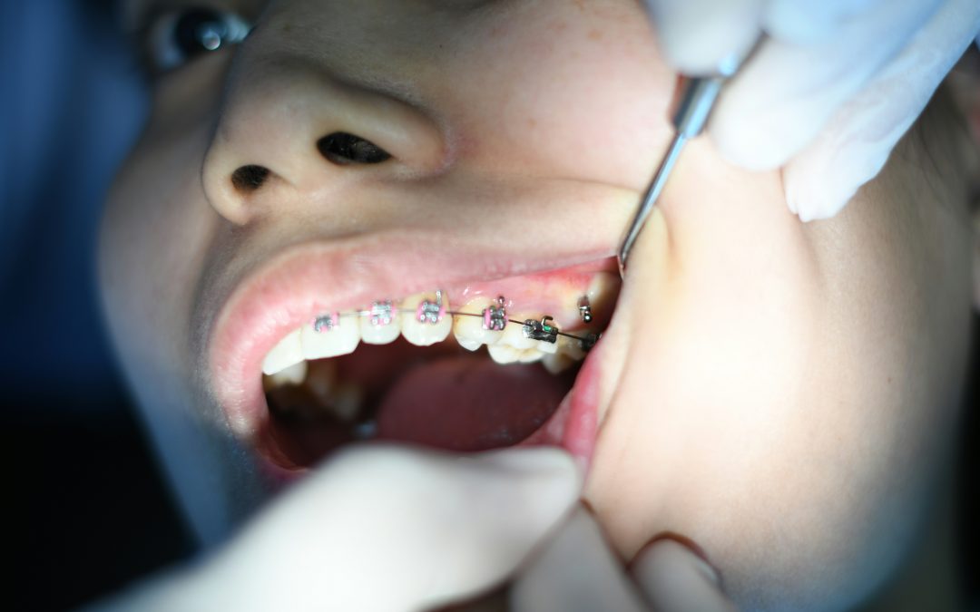 Invisalign vs Braces for Teens in St. Albert