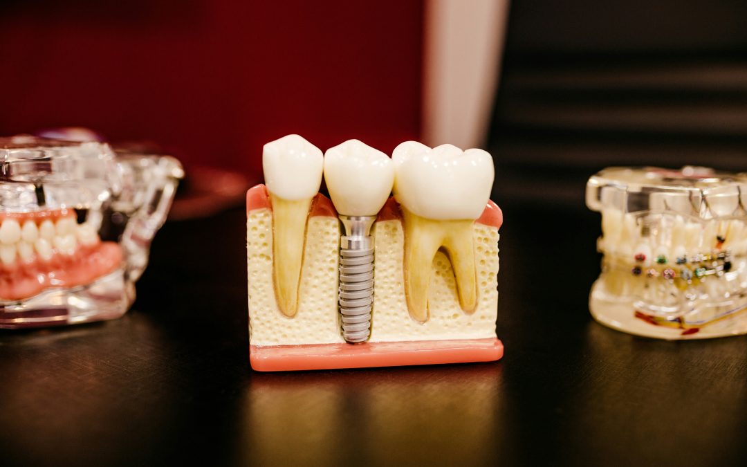 How to Prepare for a Dental Implant and Why the Timeline Matters